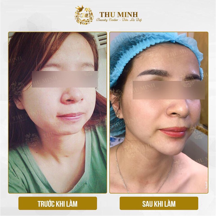 Độn cằm v line vĩnh viễn công nghệ chuẩn Hàn Quốc